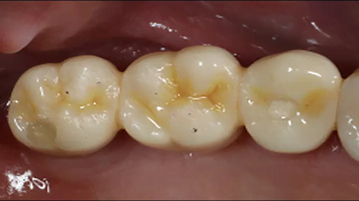 Restoration of maxillary area using rainbow™ Multi-Layer Block